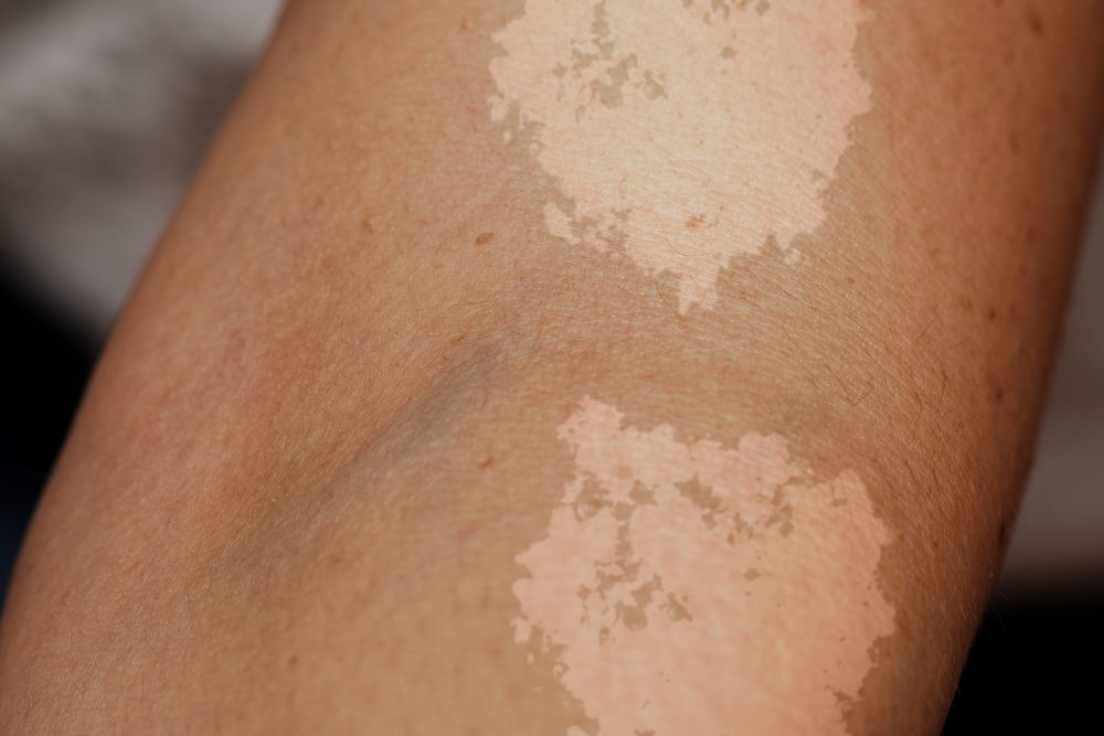 Tinea Versicolor Overview Causes Symptoms Treatment Illness