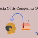 Acc — Aplasia Cutis Congenita