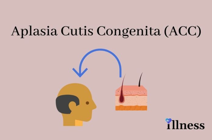 Acc — Aplasia Cutis Congenita