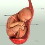 Abruptio Placenta