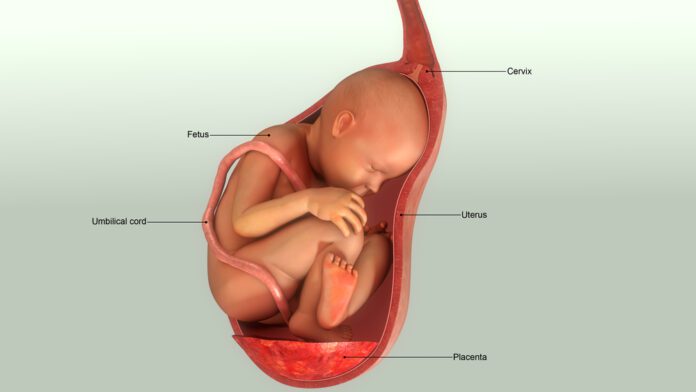 Abruptio Placenta