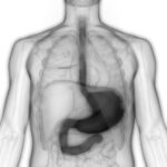 Achalasia