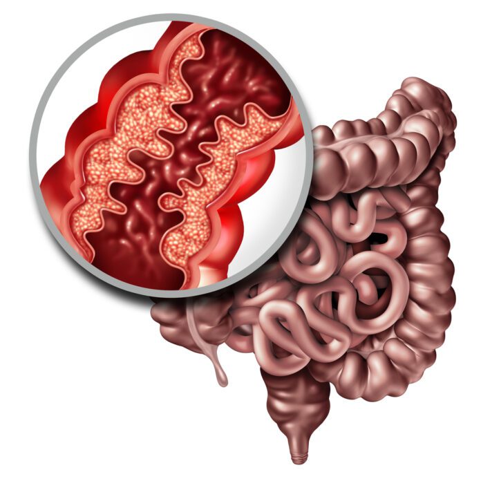 Crohn’s Disease