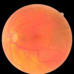 Diabetic Macular Edema