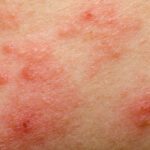 Eczema