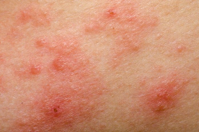 Eczema