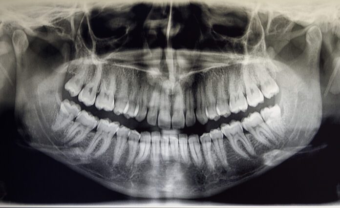 Mandibular Ameloblastoma