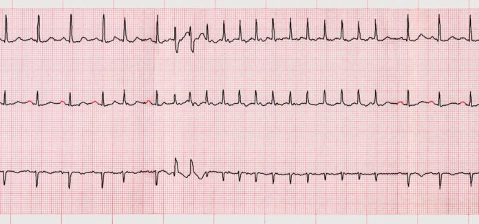 Atrial Fibrillation