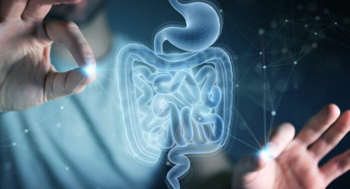 Inflammatory Bowel Disease- Crohn’s Disease