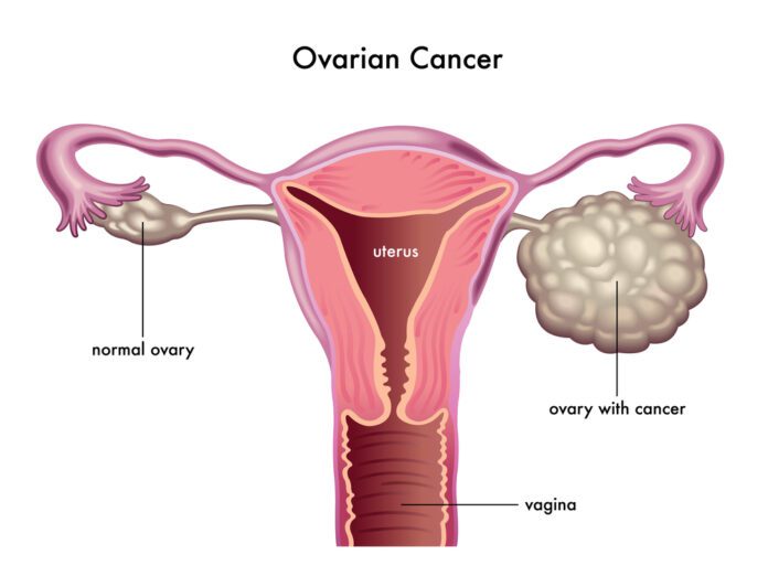 Ovarian Cancer