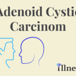 Adenoid Cystic Carcinoma