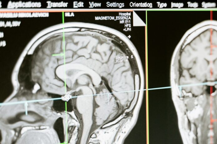 Agenesis Of Corpus Callosum