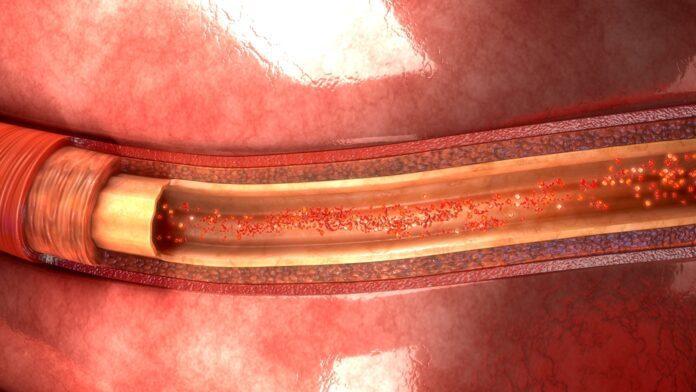 Arteriovenous Malformation