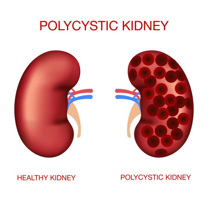 Autosomal Dominant Polycystic Kidney Disease