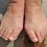 Bunions