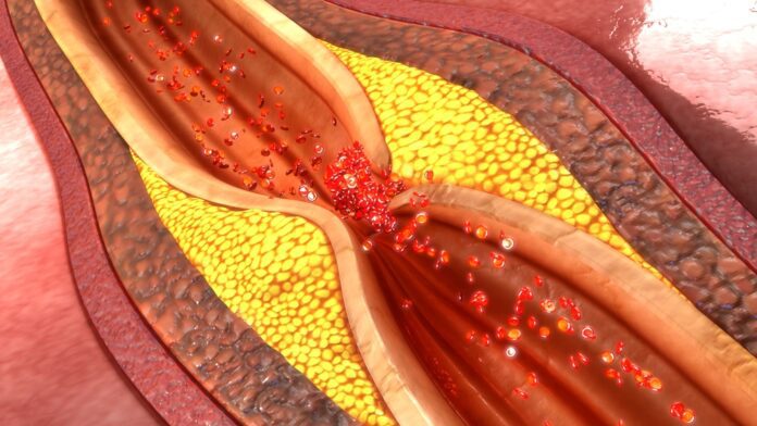 Cad (coronary Artery Disease)