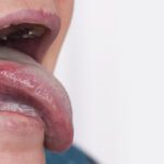 Cancer Of The Tongue
