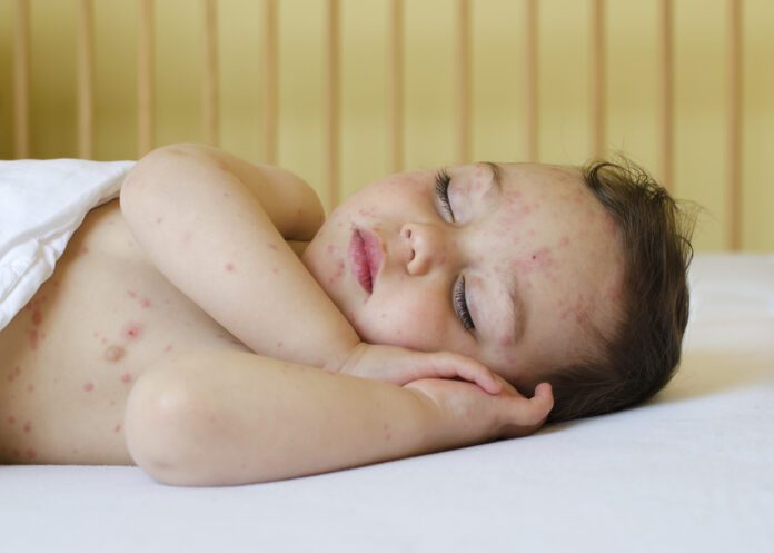 Chickenpox (Varicella)