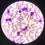 Chronic Lymphocytic Leukemia