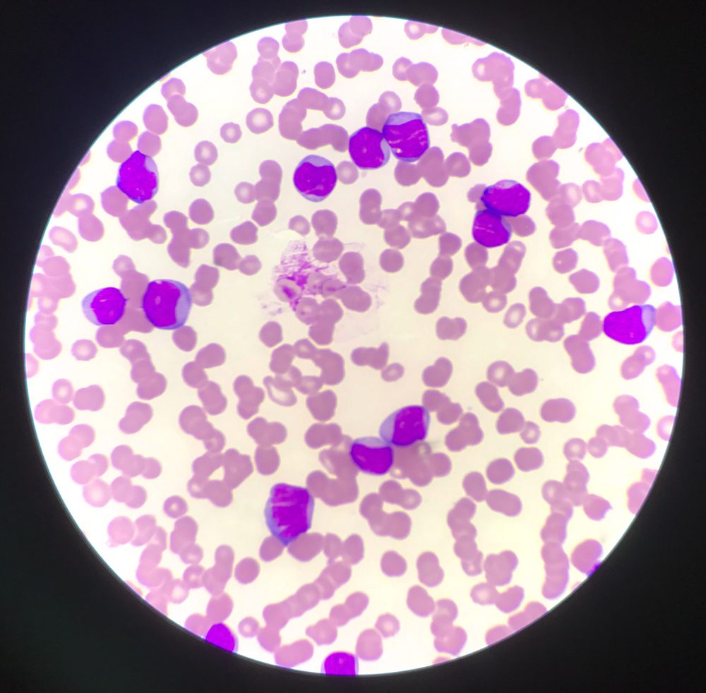 Chronic Lymphocytic Leukemia : Overview, Causes, Symptoms, Treatment