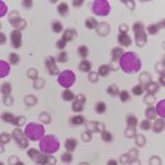 Chronic Myelogenous Leukemia