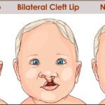 Cleft Lip And Cleft Palate