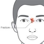 Nose Fracture