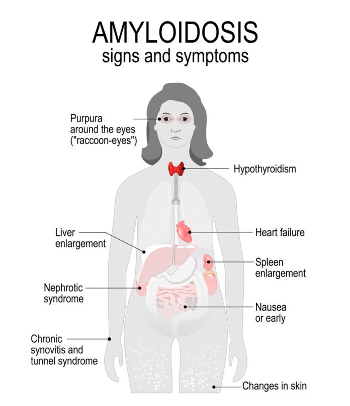 Primary Amyloidosis