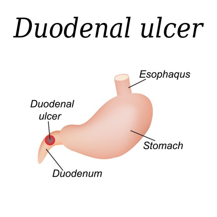 Duodenal Ulcer