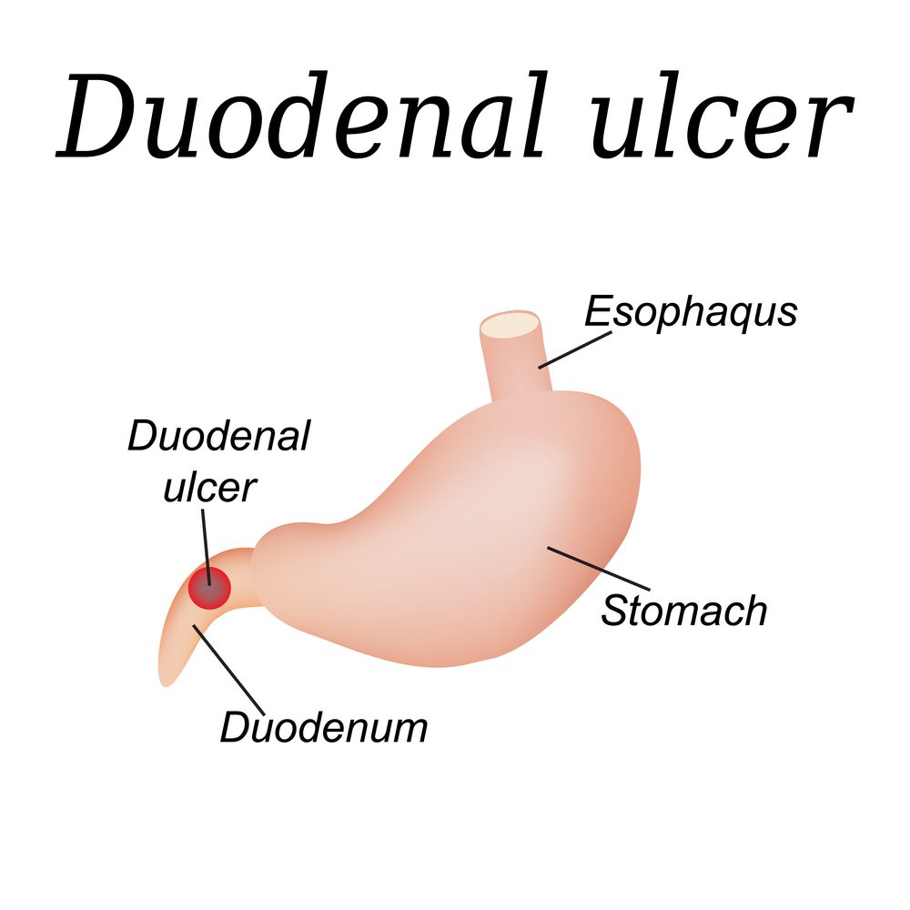 ulcer duodenal)
