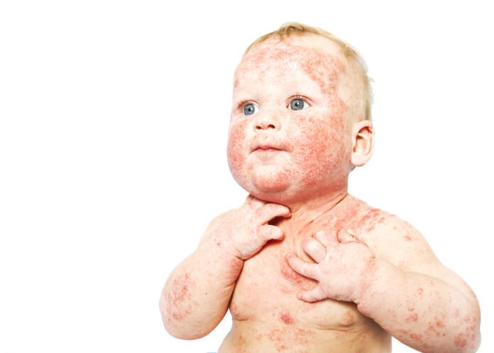 Dermatitis - Atopic