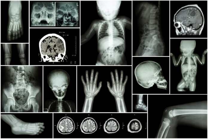 brittle-bone-disease-illness