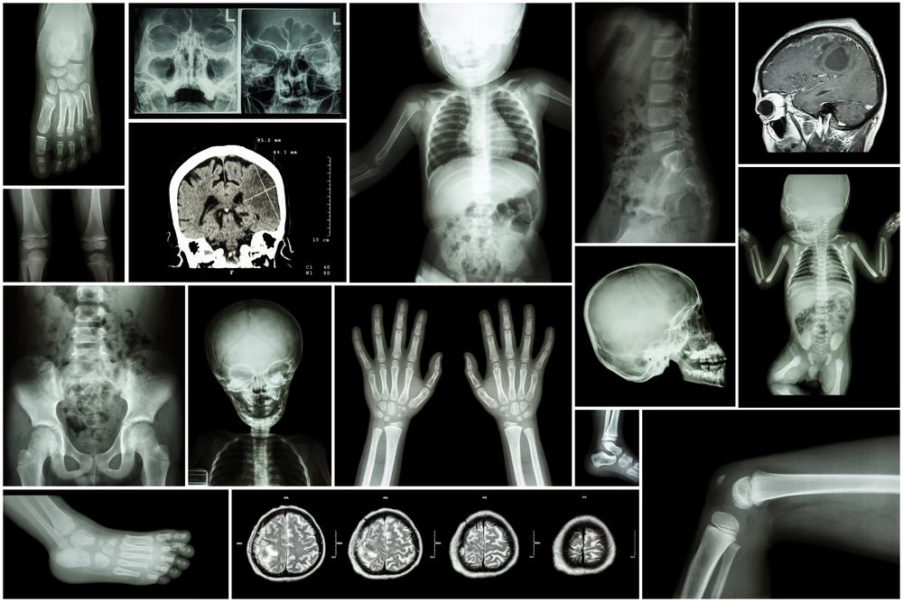 Brittle Bone Disease : Overview, Causes, Symptoms, Treatment - illness.com