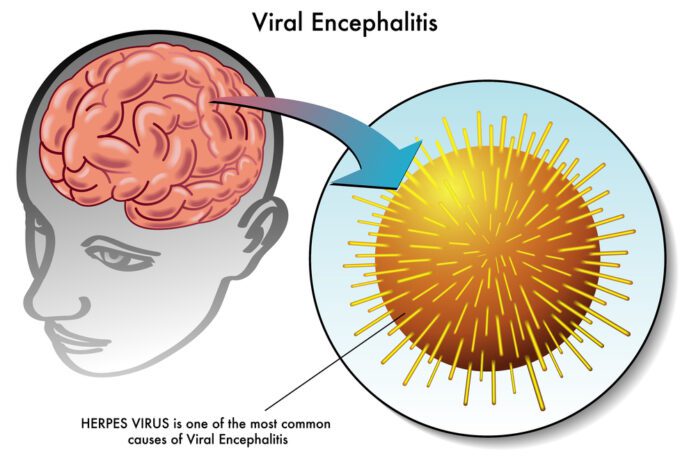 Encephalitis