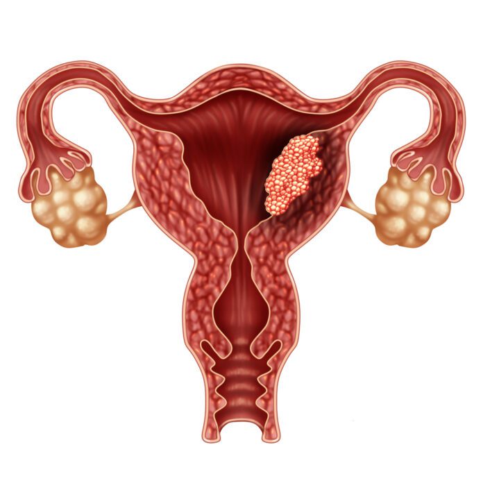 Endometrial Cancer