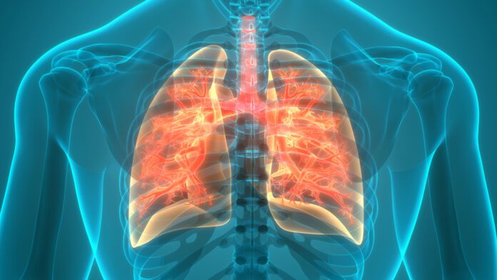 Idiopathic Pulmonary Fibrosis