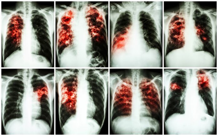 Fibrous Interstitial Pneumonia