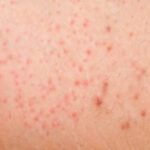 Folliculitis