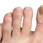 Fungal Nail Infections