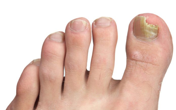 Fungal Nail Infections