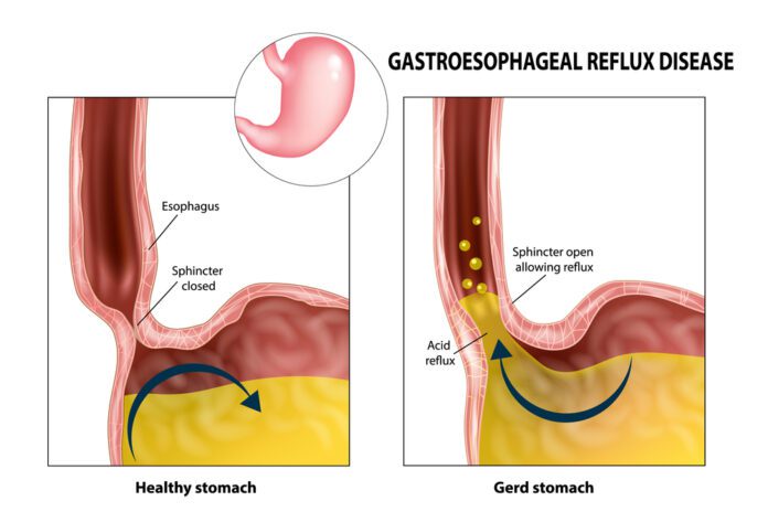 Gastroesophageal Reflux Disease (GERD)