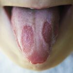 Geographic Tongue