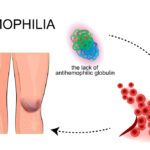 Hemophilia A