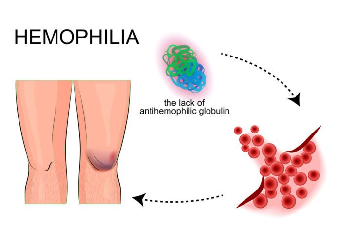 Hemophilia A