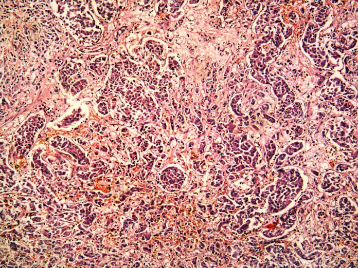 Hepatocellular Carcinoma