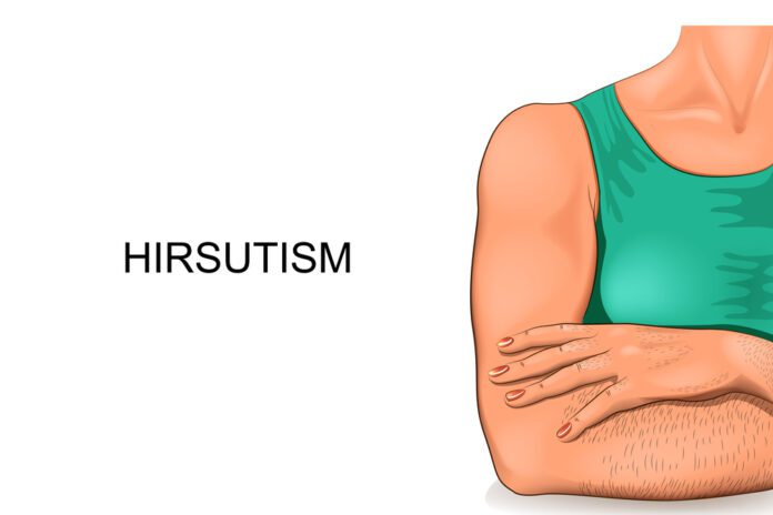 Hirsutism