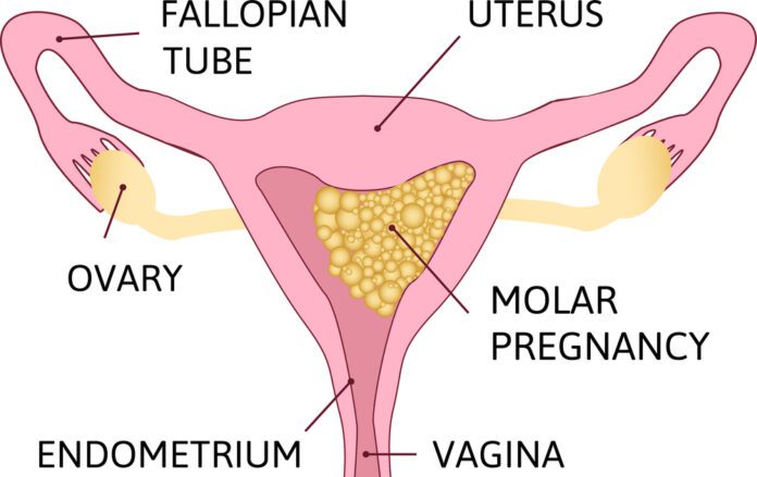 Hydatid Mole