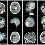 Primary Familial Brain Calcification