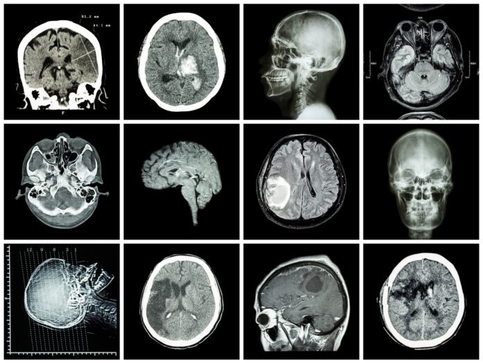 Primary Familial Brain Calcification