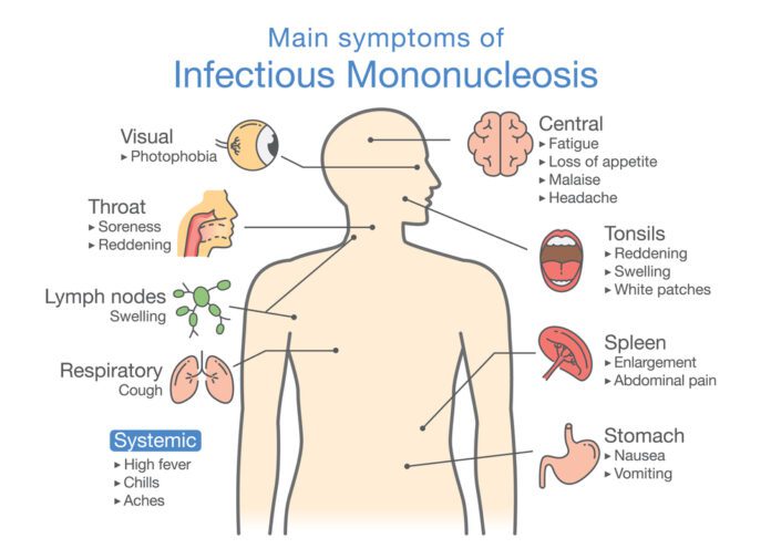 Infectious Mononucleosis